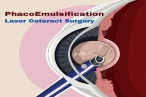 Phaco Emulsification