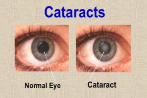 cataract eye