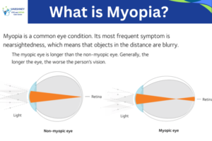 what is myopia