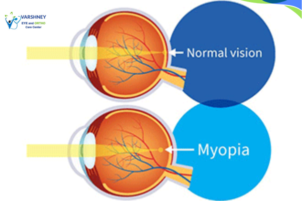 Myopia